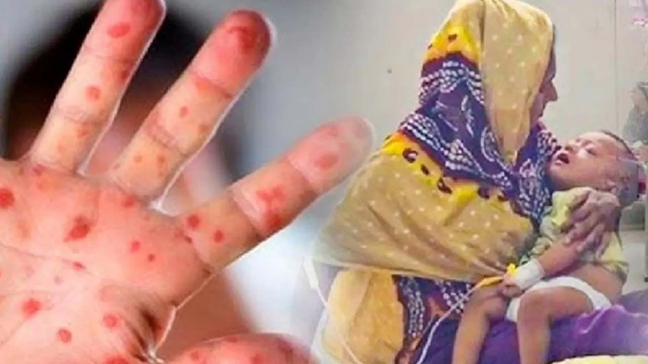 হাম ও হামের উপসর্গ নিয়ে আরও ১০ শিশুর মৃত্যু