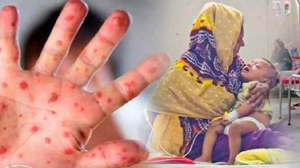হাম ও হামের উপসর্গে আরও ১২ জন শিশুর মৃত্যু