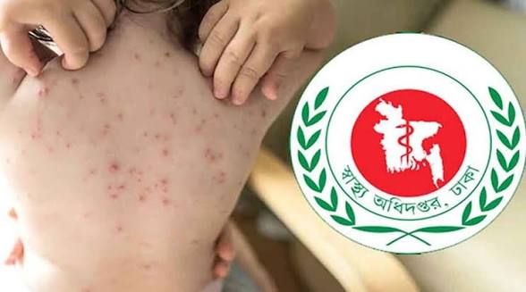 হাম ও উপসর্গে প্রাণ গেলো আরও ৮ শিশুর